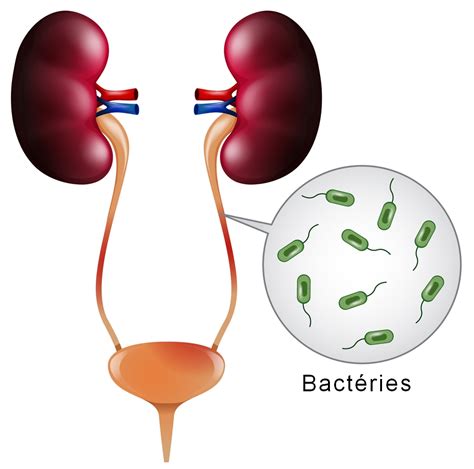 Infection urinaire: causes, symptômes, traitement et。